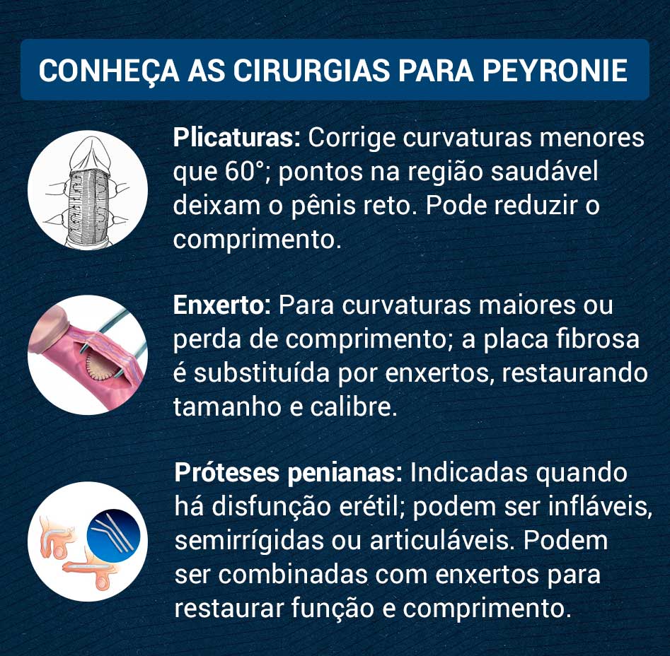 Conheça as cirurgias para Peyronie Arte - Conheça as cirurgias para Peyronie
Plicaturas: corrige curvaturas menores que 60°; pontos na região saudável deixam o pênis reto. Pode reduzir o comprimento.
Enxerto: para curvaturas maiores ou perda de comprimento; a placa fibrosa é substituída por enxertos, restaurando tamanho e calibre.
Próteses penianas: indicadas quando há disfunção erétil; podem ser infláveis, semirrígidas ou articuláveis. Podem ser combinadas com enxertos para restaurar função e comprimento.